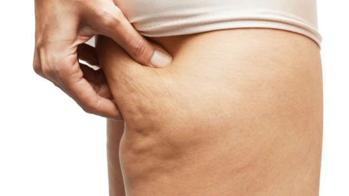 Top 8 Tips For Reducing The Appearance of Cellulite, Blog